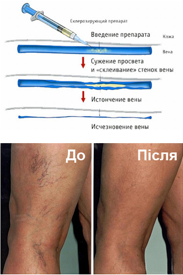 skleroterapiya-vidalennya-sudinnih-zirochok