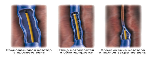 procedura-radiochastotnoy-ablyacii-ven